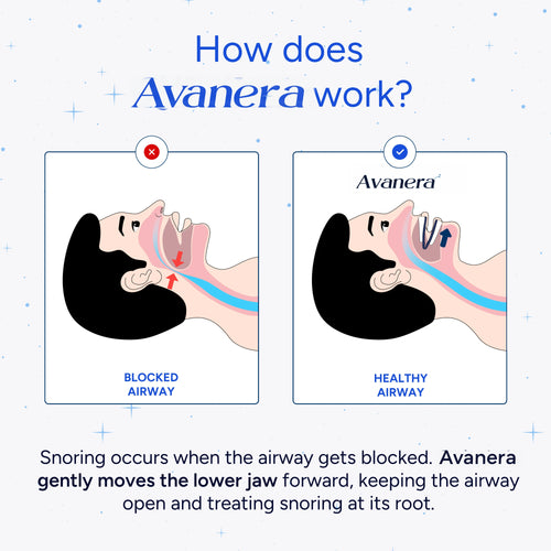 Avanera - Anti-Snoring Mouthpiece