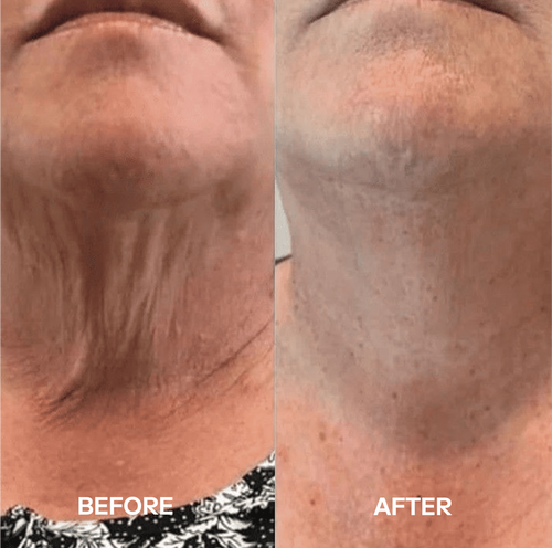 Avanera - Bio Collagen Neck Mask